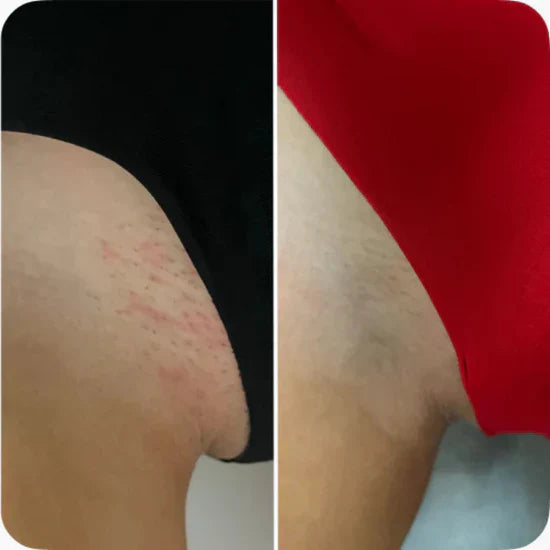 När rakning slutar göra ont